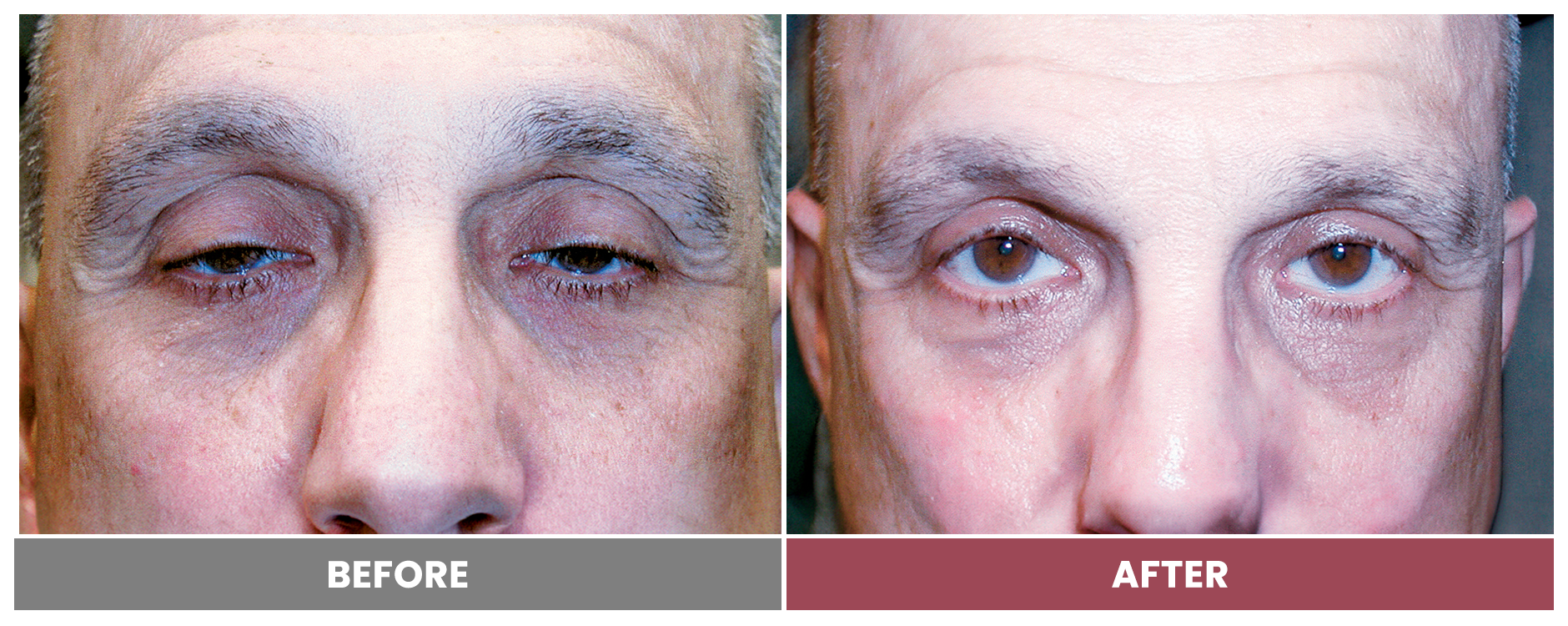 PTOSIS REPAIR - Case 3